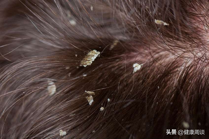 一天不洗头就有头皮屑原因是什么,隔一天不洗头头皮屑很多为什么