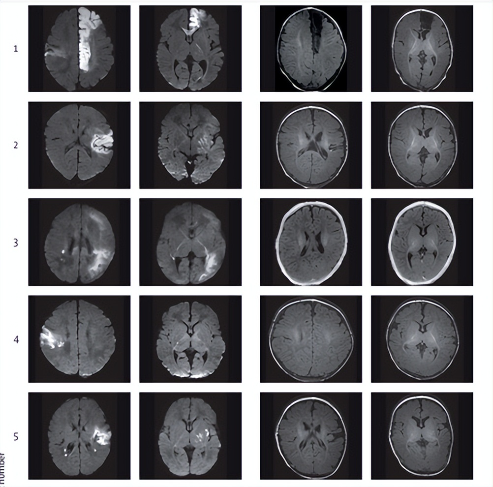 柳叶刀最新：10名中风新生儿接受了干细胞治疗，有望终身受益