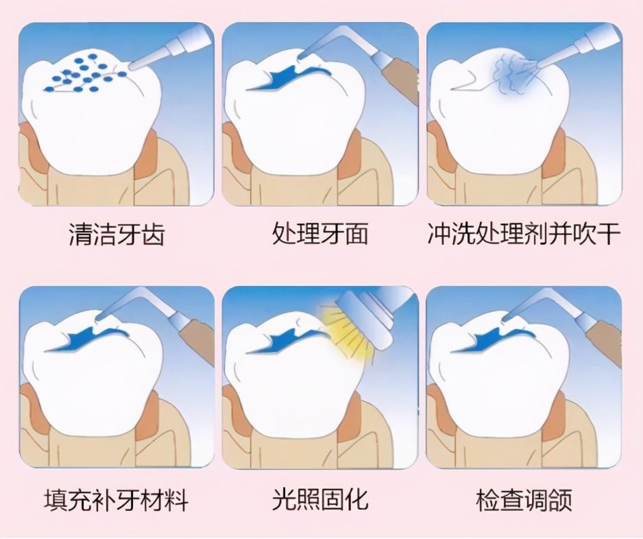 小洞不补大洞吃苦,牙齿有洞补牙全过程价目表