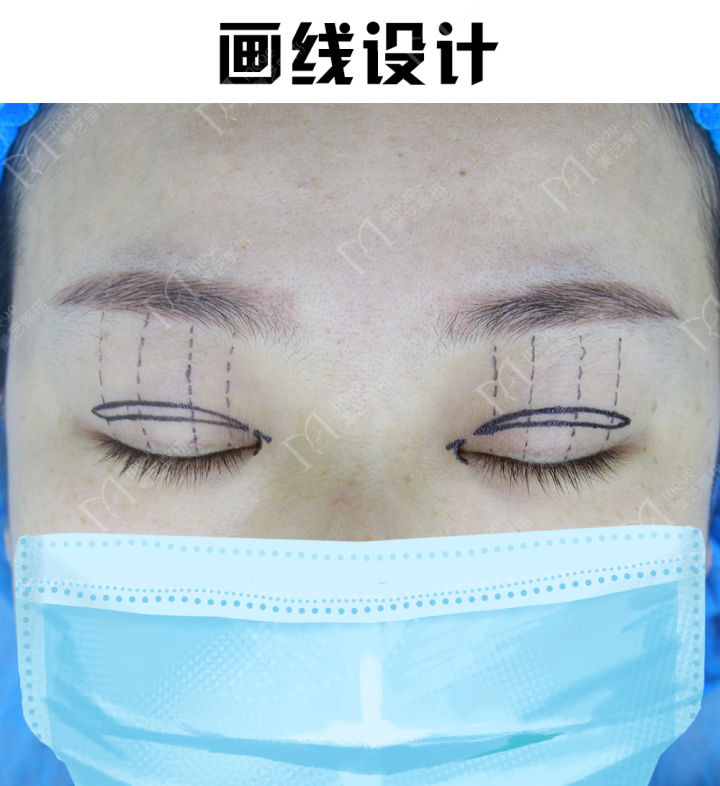 双眼皮内双和外双哪个好看,双眼皮贴内双变外双