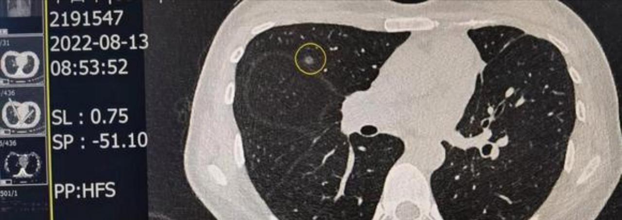 肺癌手术后什么时候能彻底恢复,肺癌手术后什么方法减轻病人痛苦