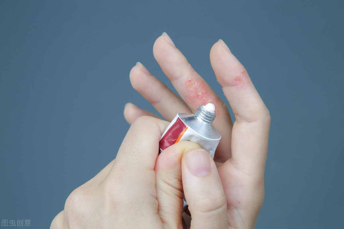 湿疹过敏引起皮肤发红怎么办,治疗湿疹过敏的药有哪些