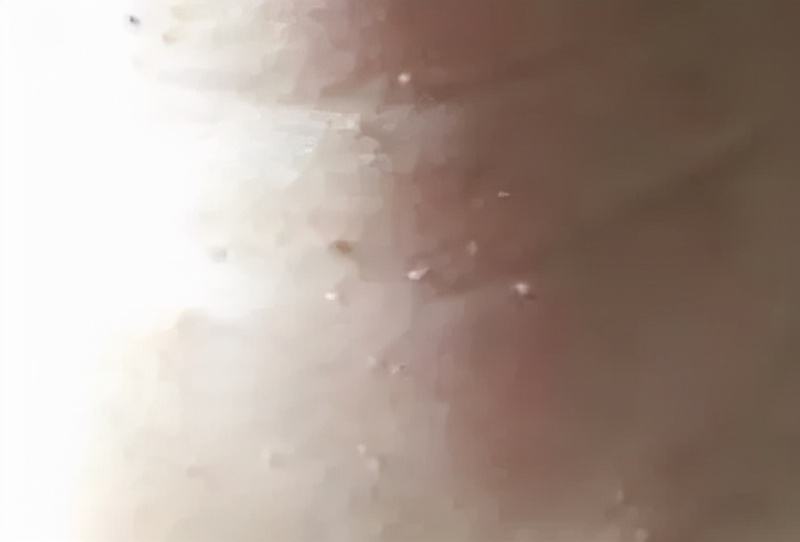 怀孕后脖子上长丝状疣以后会掉吗,怀孕脖子上长了好多小疹子