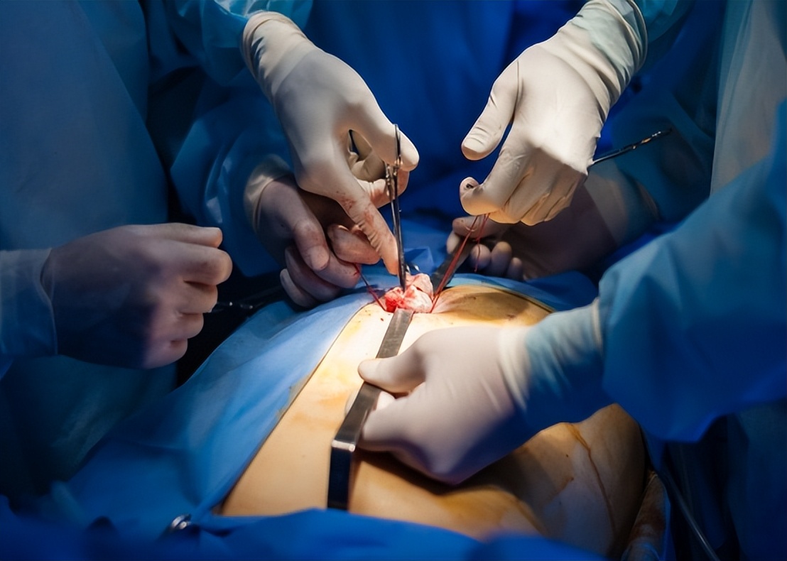 胆囊结石看中医还是西医好,胆囊有泥沙样结石中医怎么治疗