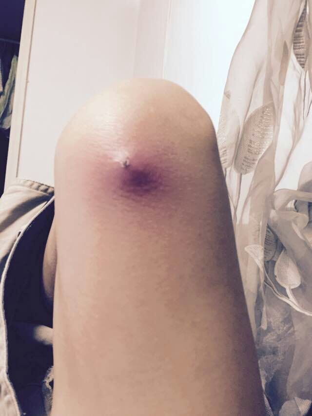 腋下及大腿根部起红疹,大腿和腋下反复长湿疹