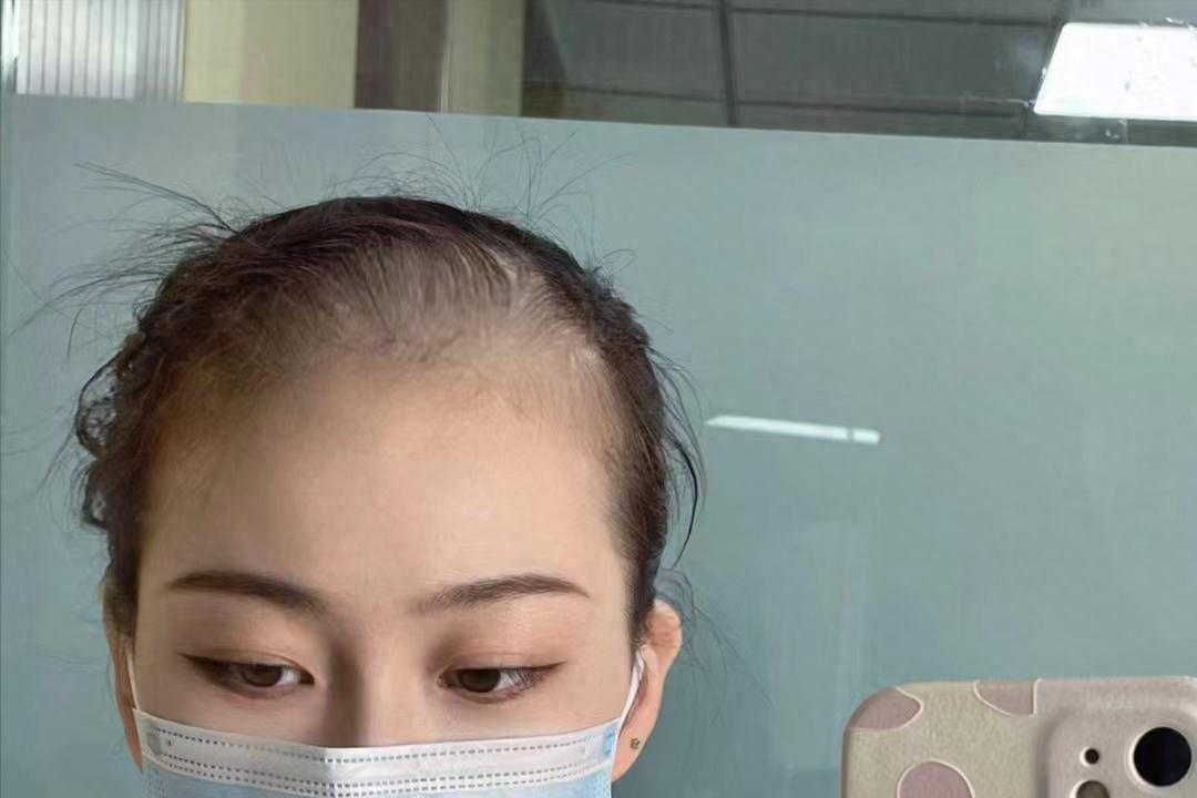 怎么克服脱发最有效,摆脱脱发困扰的小妙招