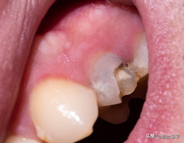 牙髓炎最后会发展成什么样,牙髓炎不及时治疗的危害