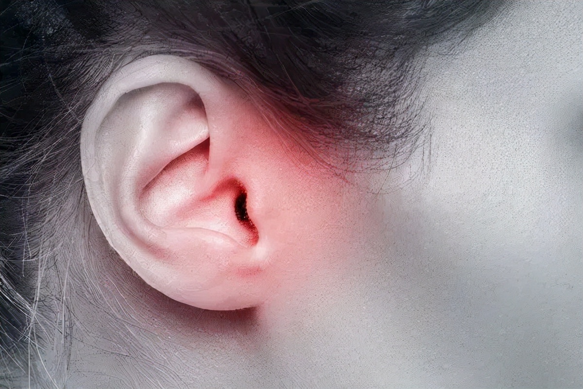 耳朵后面腮腺肿瘤早期症状和感觉,耳后腮腺处有良性肿瘤该挂什么号