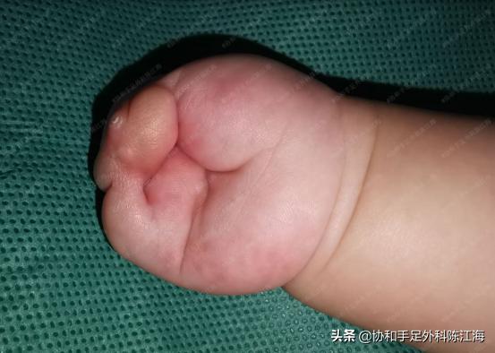 束带综合征手术多大可以做,束带综合征动手术后期有影响吗