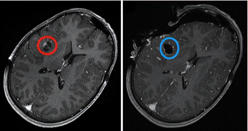 小儿脑瘤并非都治愈无望！家长关心的热点问题汇总答疑