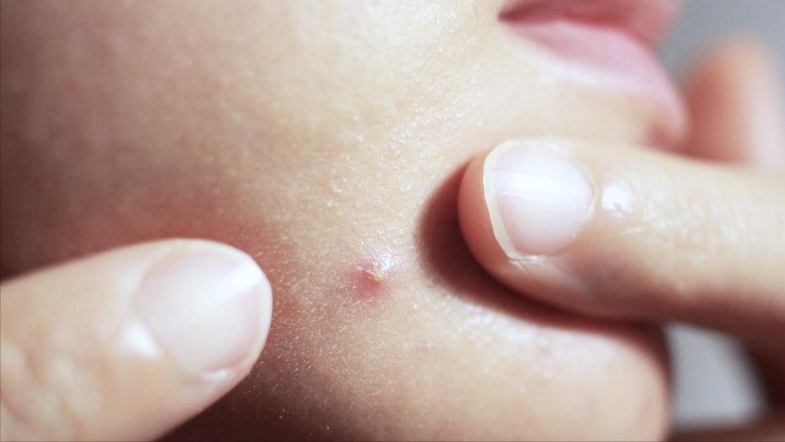 青春期面上长疮该吃什么,青春期顽固痤疮怎么样治疗才能好