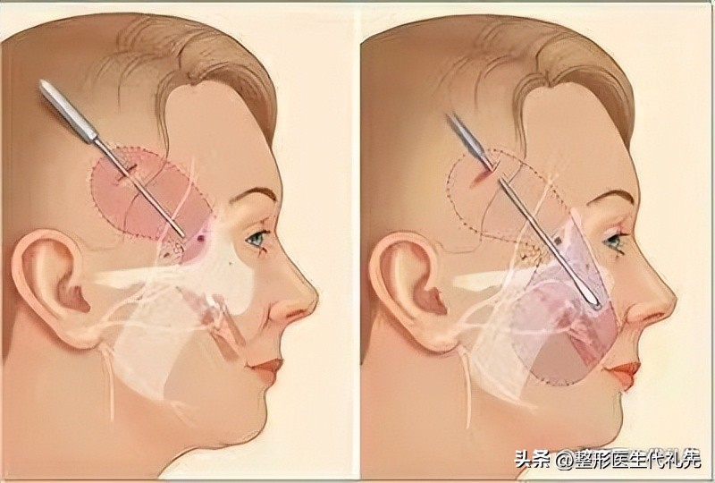 耳后额头拉皮是大拉皮还是小拉皮,拉皮手术在哪个季节做最合适