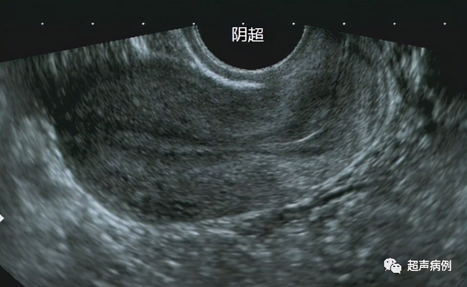 做阴道B超是一种什么样的体验?