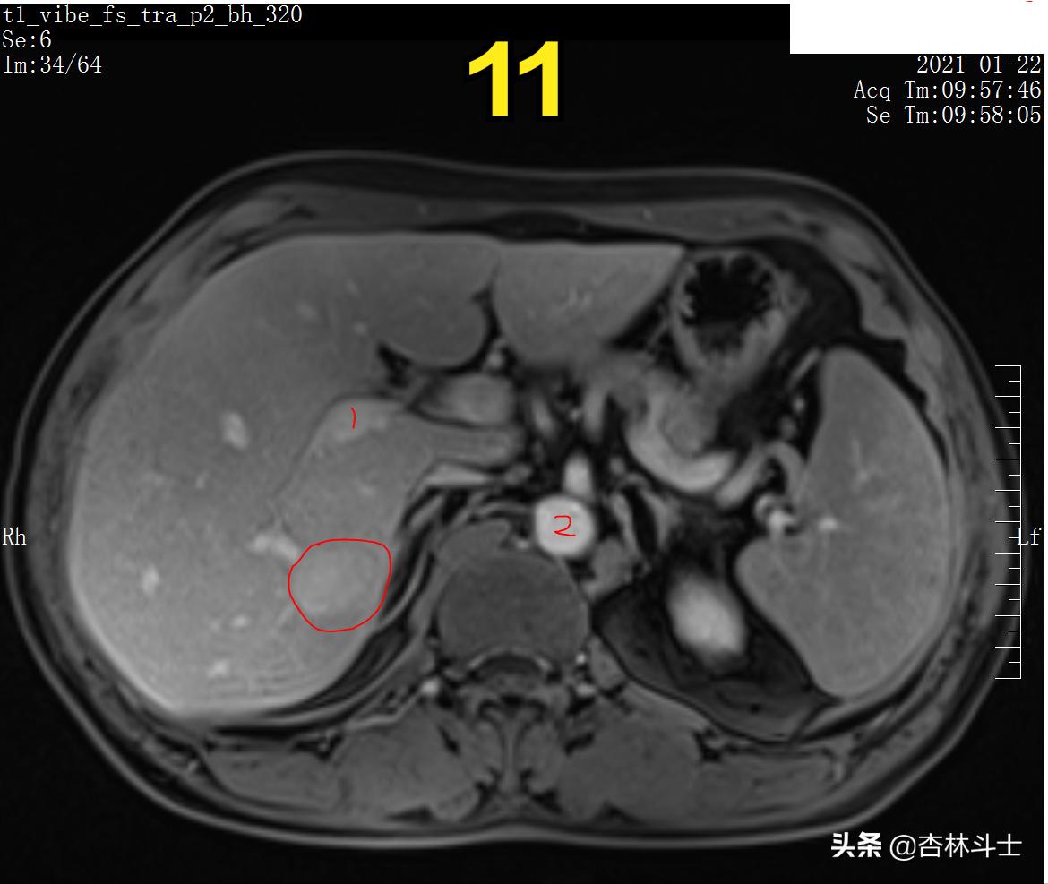 肝癌8公分肿瘤能活多久,肝癌细胞最大长多大
