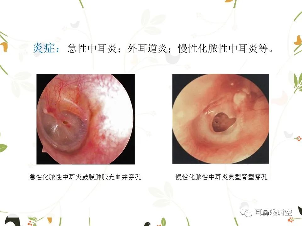 鼓膜可见穿孔,鼓膜穿孔听力下降能恢复吗