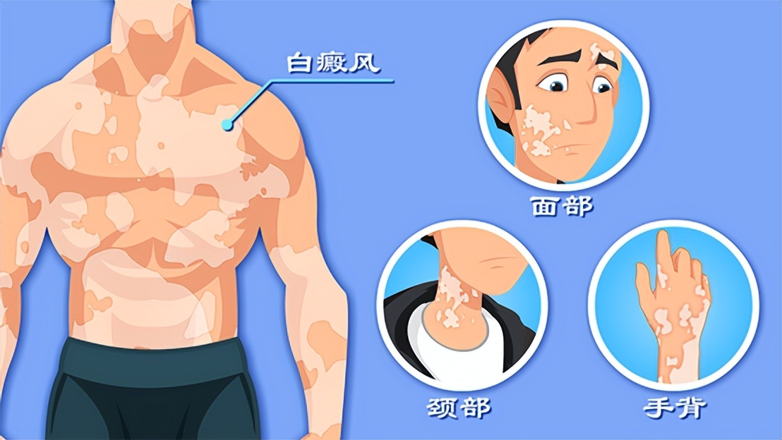 白斑是白癜风还是糠疹如何鉴别呢,白斑处毛发变白就一定是白癜风吗