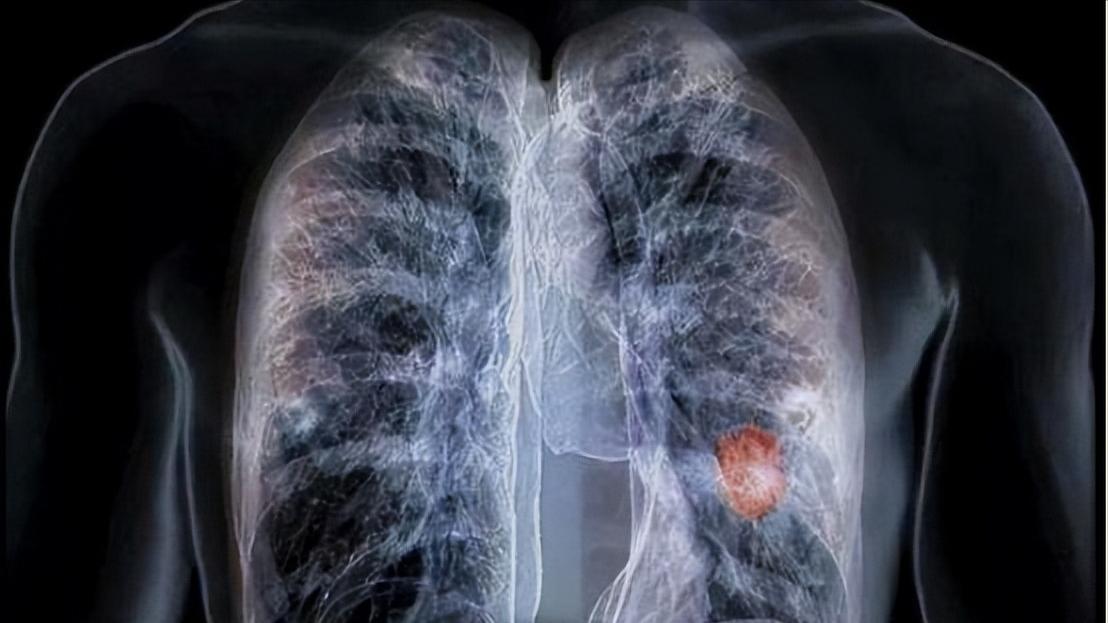 体检查出肺结节可以不调理吗,体检微小肺结节是什么