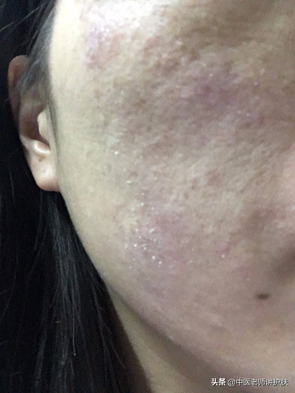 激素依赖性皮炎真相,激素依赖性皮炎的病因