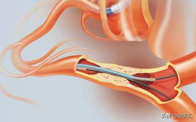 栓塞介入能消灭肿瘤吗,手术不用刀