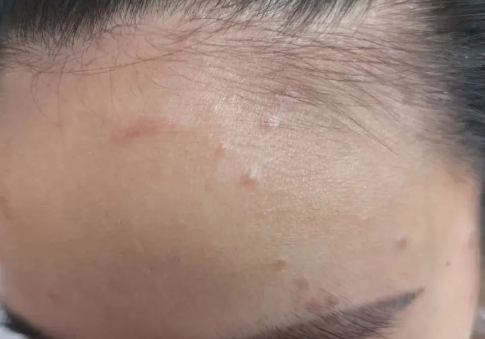 hpv和艾滋病怎么传染,hpv和疣有什么关系