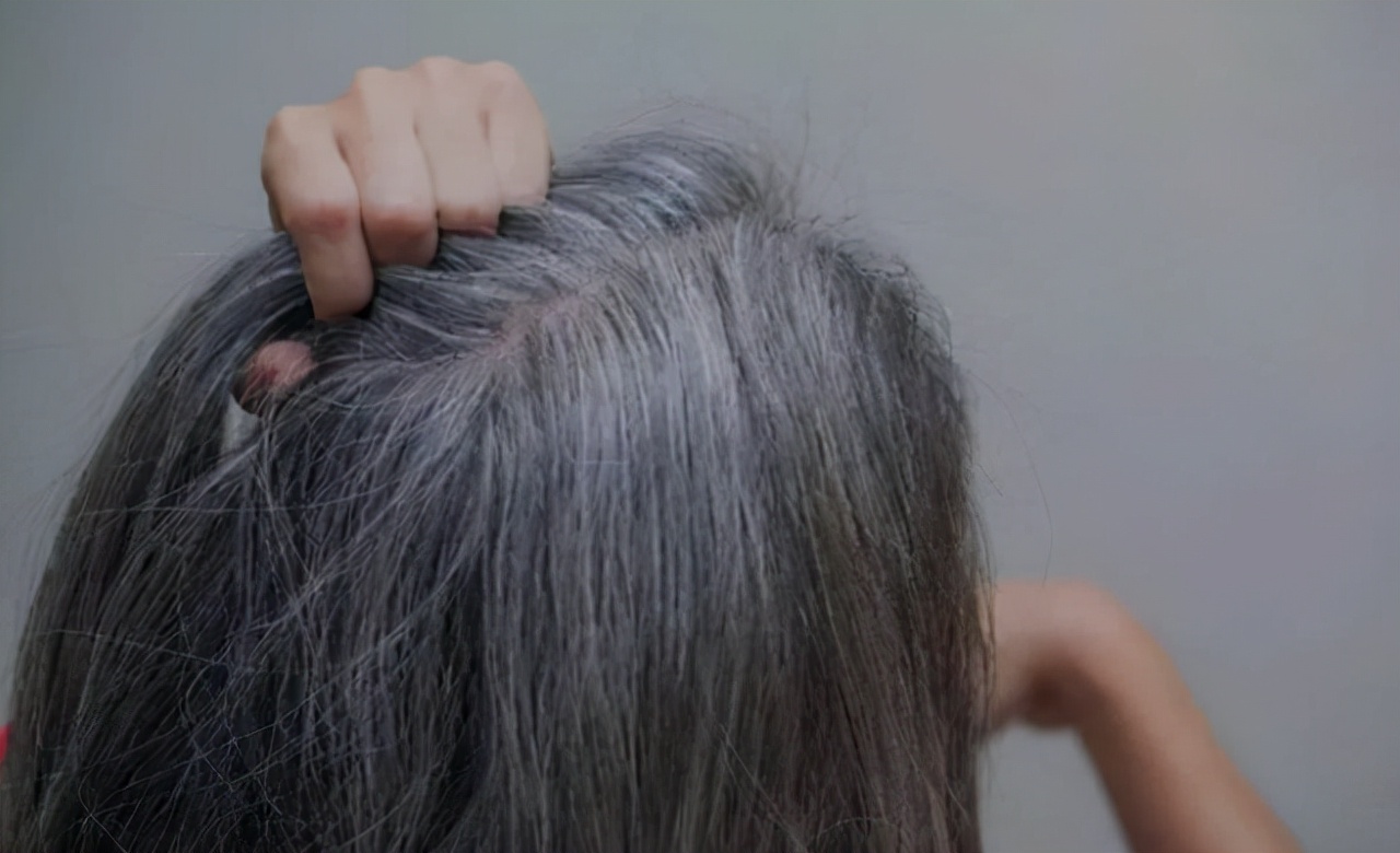 女性头上有白发应该补充什么,女性头顶白发什么原因怎么调理