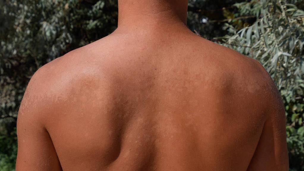 麻疹出不透的危害,麻疹和荨麻疹有什么危害