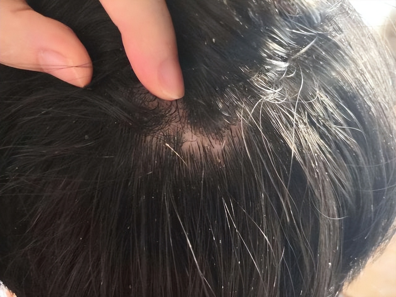 头皮后脑勺长红疙瘩有脓包,为什么头皮上总是长脓包和痘痘