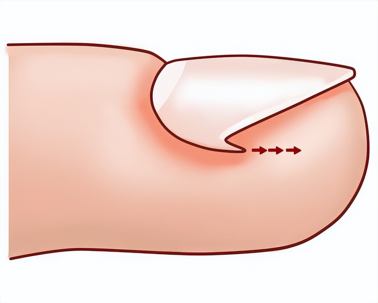甲沟炎痛的无法剪指甲怎么办,甲沟炎清理过了为什么还是痛