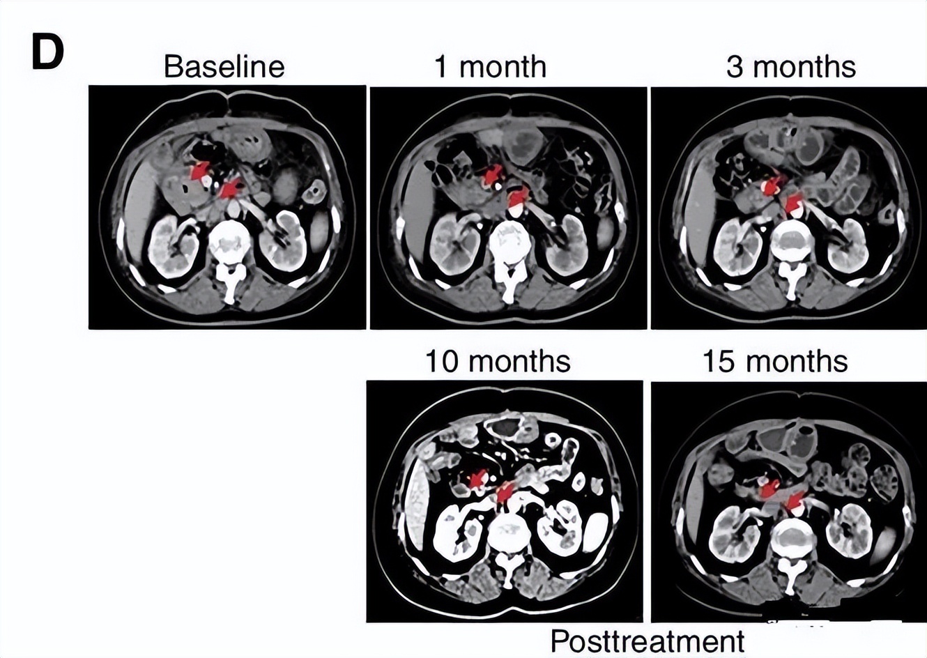 免疫疗法抗肿瘤效果图,央视新闻报道免疫细胞治疗癌症