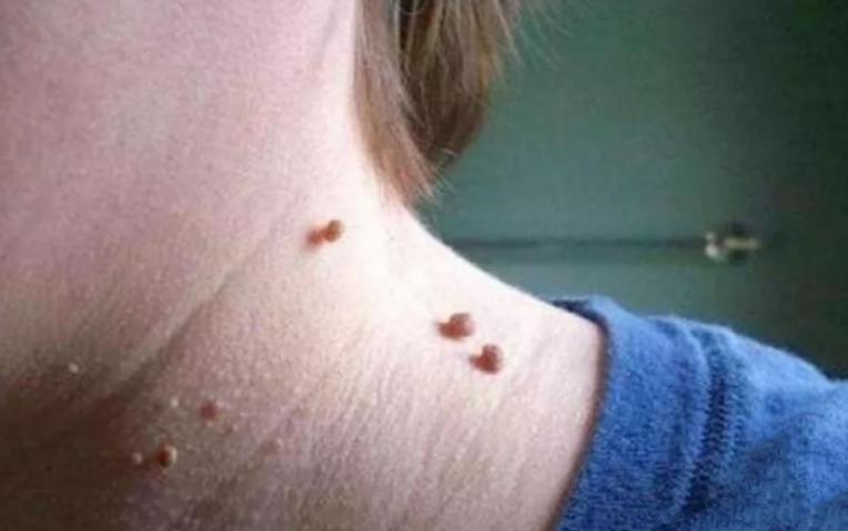 皮肤长的小肉球怎么自己处理,皮肤长出小肉球是什么原因