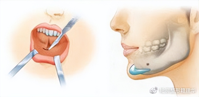 下巴后缩要怎么整形,下巴后缩做什么手术矫正
