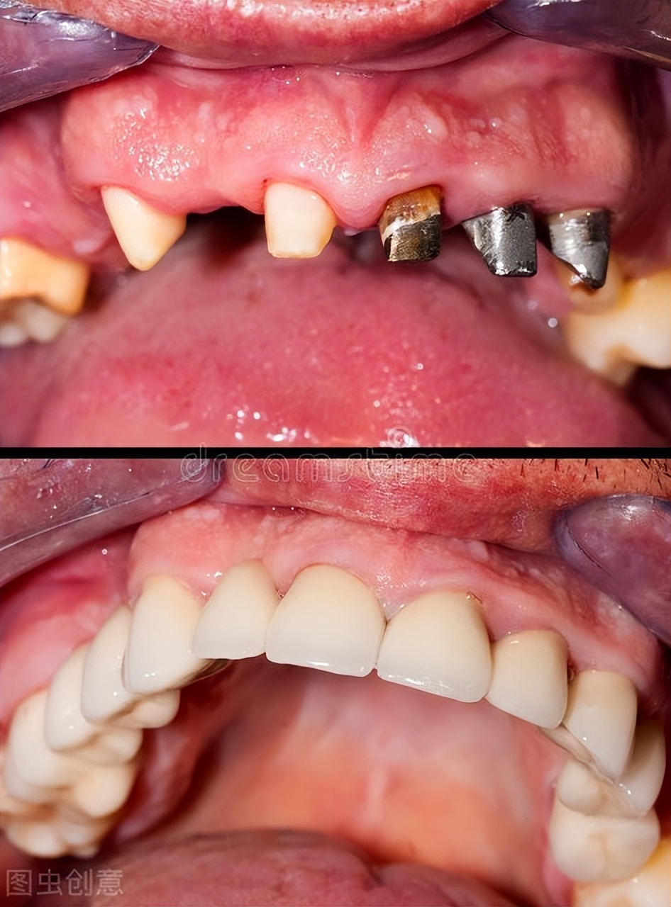 不用洗牙能把牙垢黄牙变白的方法,黑黄牙如何快速变白牙图片