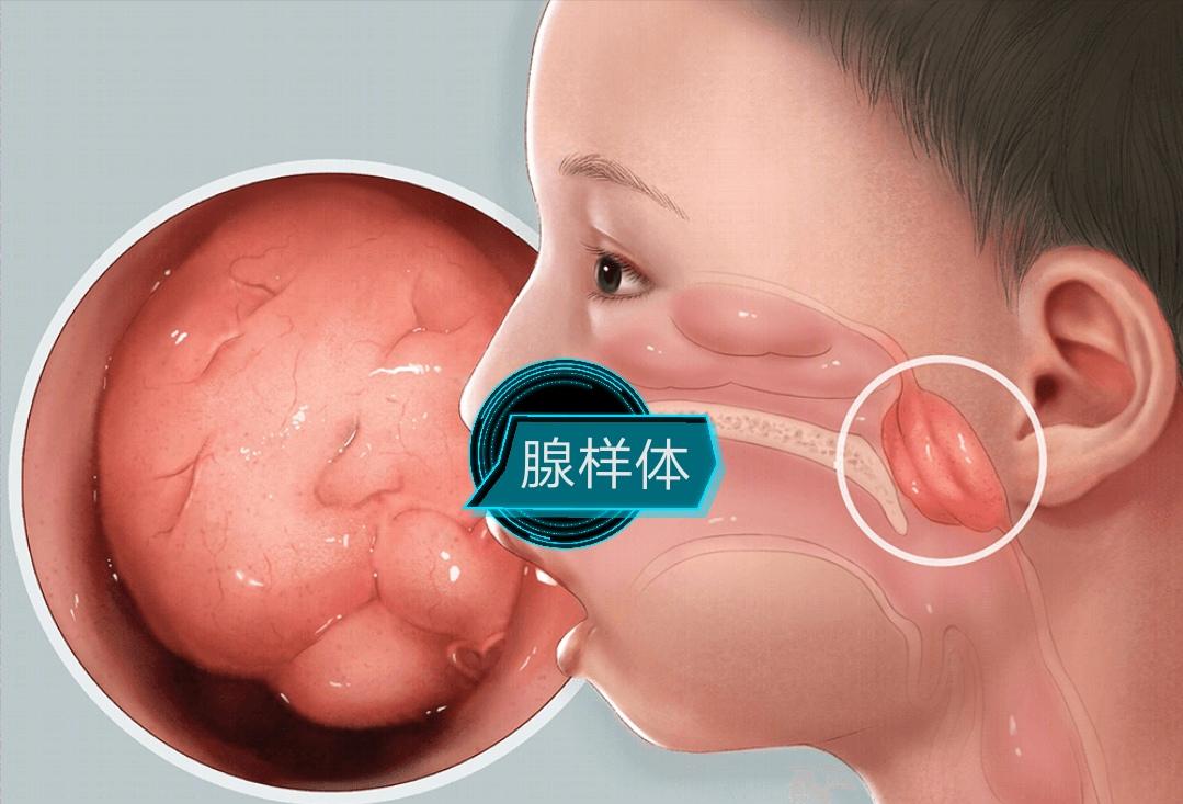 腺样体肥大可以吃炖鸡蛋吗,腺样体的克星中药