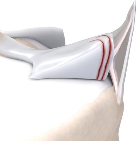 查半月板是拍片还是磁共振,半月板核磁共振影像诊断