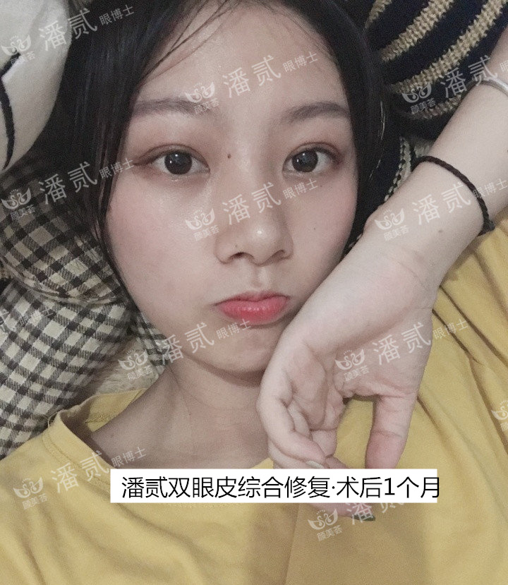 双眼皮贴导致眼皮破了,双眼皮贴导致眼皮严重下垂恢复