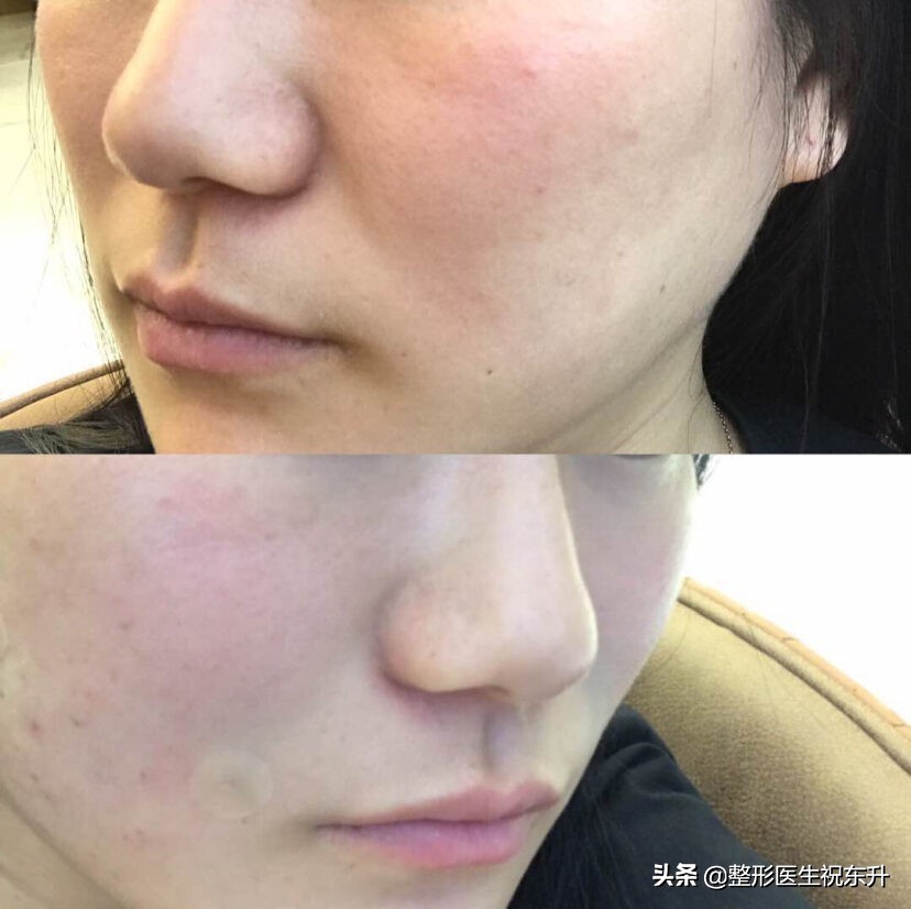 消除法令纹和嘴角纹最好的方法,法令纹怎么消除简单方法