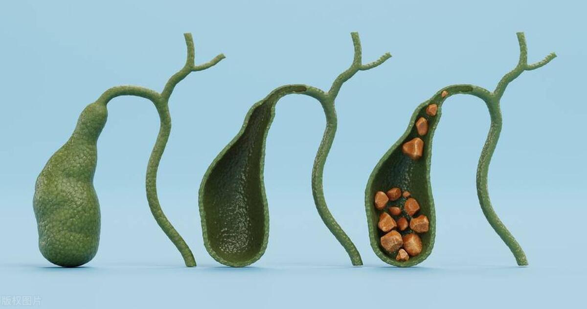 胡博士治疗胆囊息肉——息肉彩超怎么看？