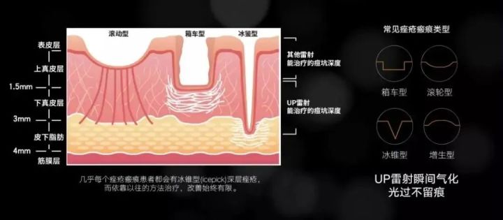 plasma和点阵激光祛痘坑哪个好,点阵激光仪去痘坑前后对比