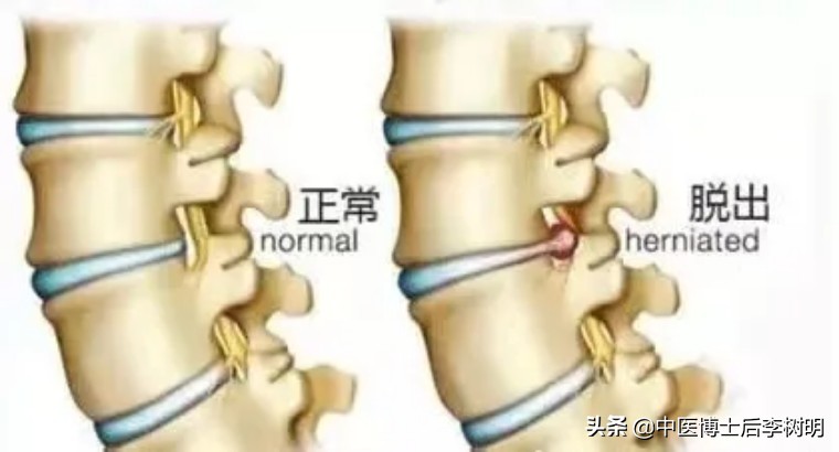 45岁突然腰痛是什么原因,45岁老人腰痛