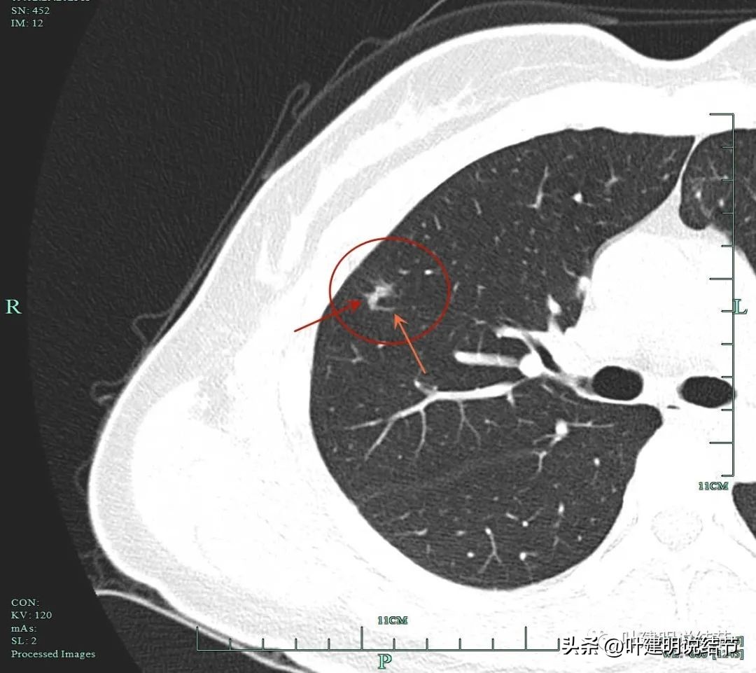 磨玻璃结节伴有增生是癌症吗,磨玻璃结节会是别的癌转移的吗