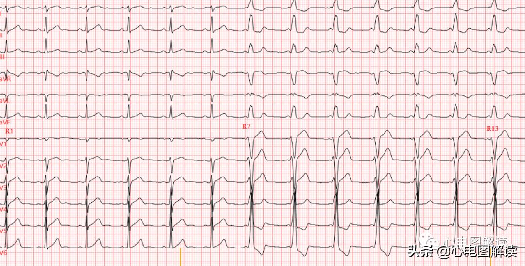 房性早搏与预激综合征,房性早搏伴阵性心动过速