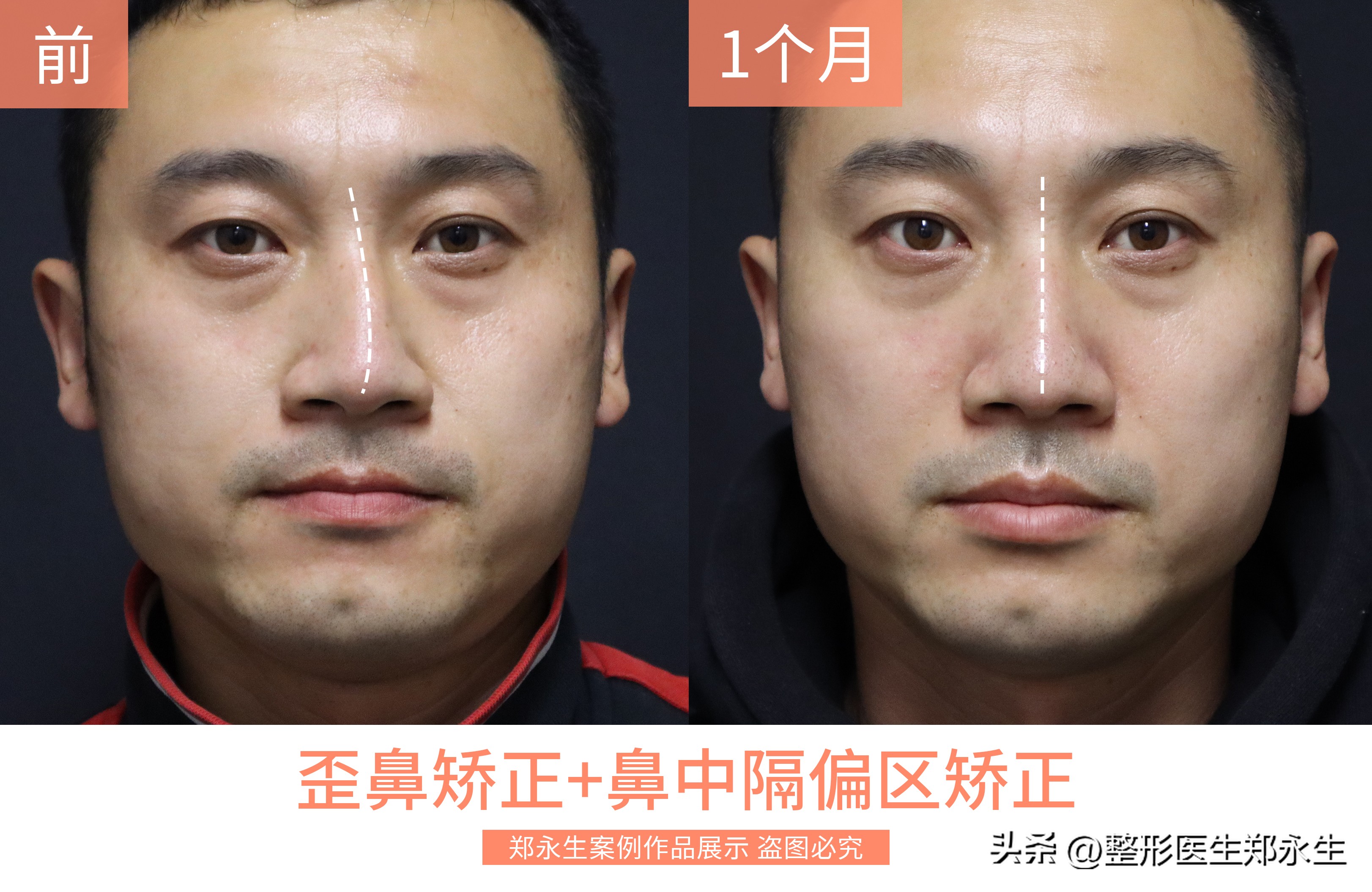 塌鼻和歪鼻如何处理,歪鼻原因