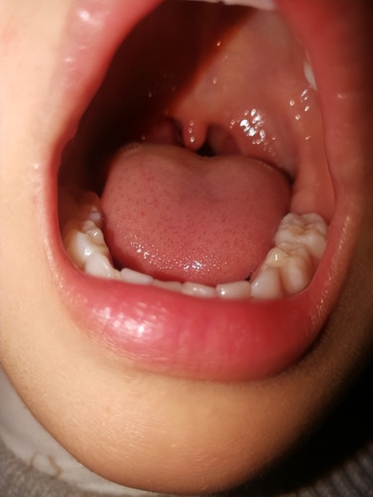 化脓性扁桃体炎中医怎么治,儿童化脓性扁桃体炎中医怎么治疗