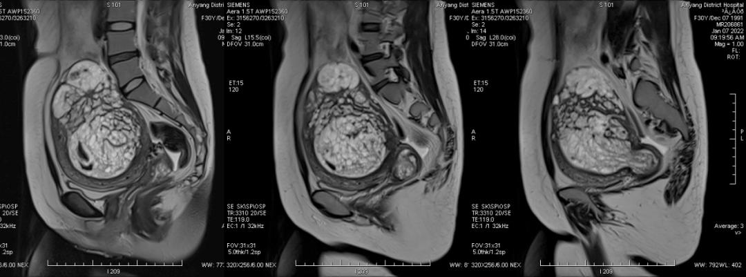这么典型的葡萄胎MRI影像，快来学习吧
