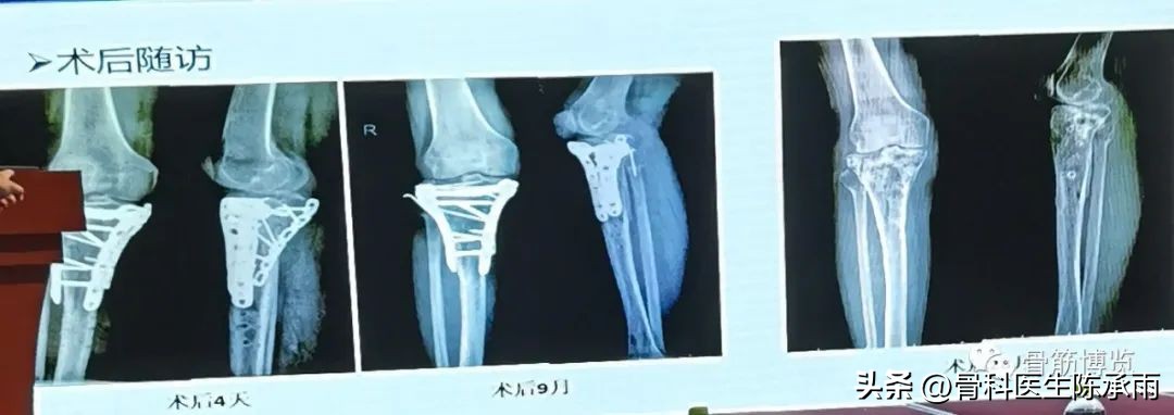 国家卫健委主办的骨创伤专项能力培训项目----下肢损伤学习班