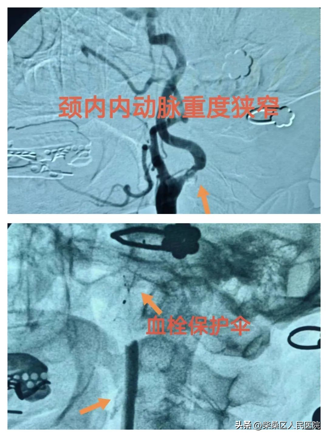 柴桑区人民医院一周手术选播（第二期）
