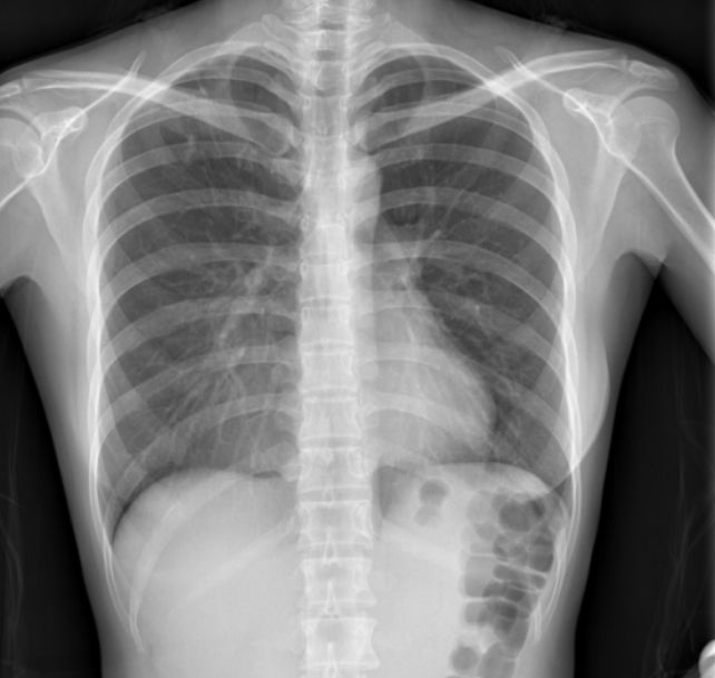 肺结核在被折磨三个多月后，被中医拯救了