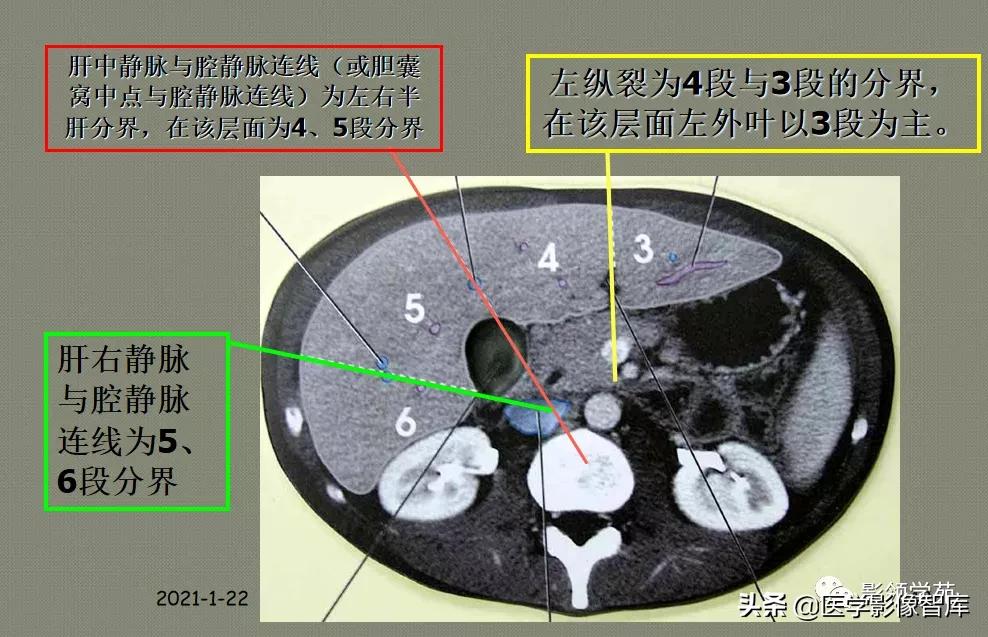 肝脏影像分叶分段解剖图,肝脏分段解剖图谱