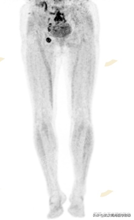 罕见卵巢恶性肿瘤,肿瘤罕见病