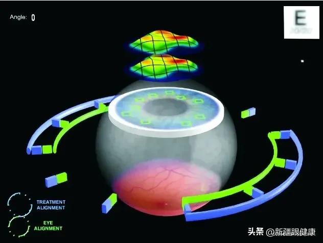 NBA球迷看过来：詹皇同款摘镜术式